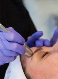 Microderm a client receiving Microderm abrasion on the forehead.